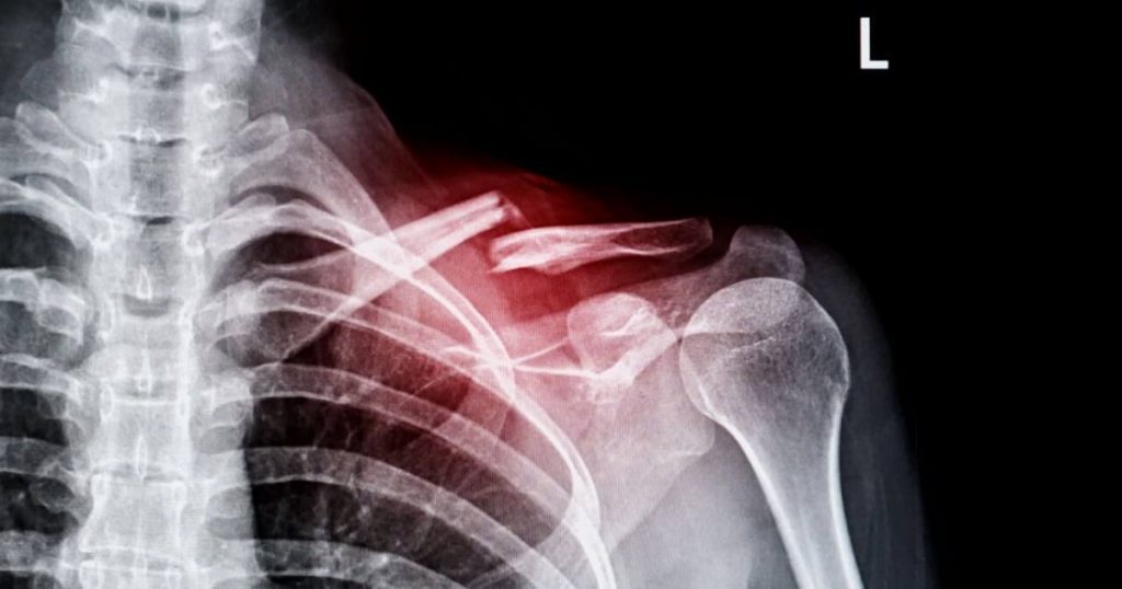 Dr Thiago Martins: tratamento de fratura de  clav&iacute;cula